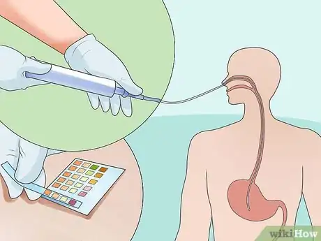 Image titled Insert a Nasogastric (NG) Tube Step 13