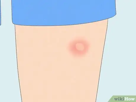 Image titled Identify Insect Bites Step 1