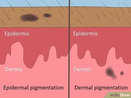 Image titled Remove Sunburn Patches (for Indian Skin Types) Step 6