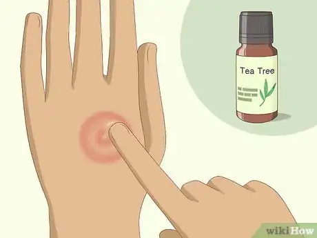 Image titled Get Rid of Ringworm Naturally Step 1