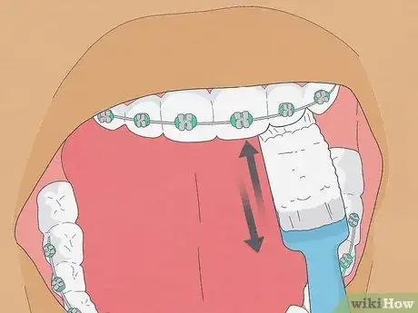 Image titled Brush Your Teeth With Braces On Step 2