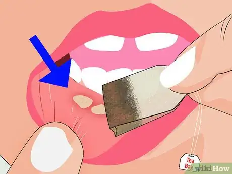 Image titled Avoid Getting Canker Sores Step 9