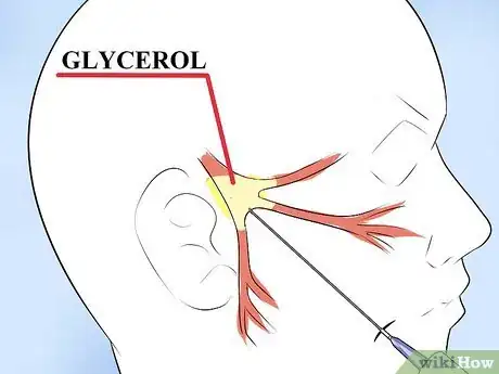 Image titled Alleviate Pain Caused by Trigeminal Neuralgia Step 9