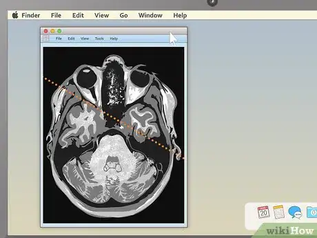 Image titled Read an MRI Step 9