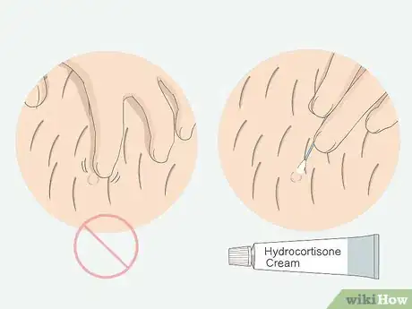 Image titled Get Rid of Ingrown Pubic Hair Step 3