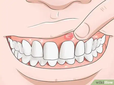 Image titled Reduce Gum Swelling Step 1