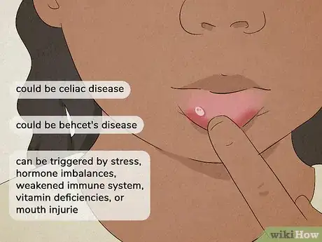 Image titled Relieve Canker Sore Pain Step 2