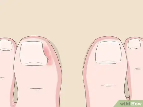 Image titled Relieve Ingrown Toe Nail Pain Step 1