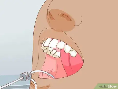 Image titled Unclog a Salivary Duct Step 12