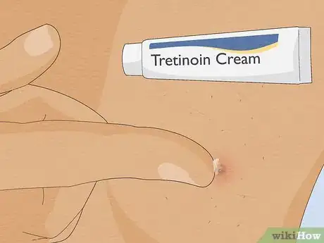 Image titled Remove an Ingrown Hair Under the Skin Step 10