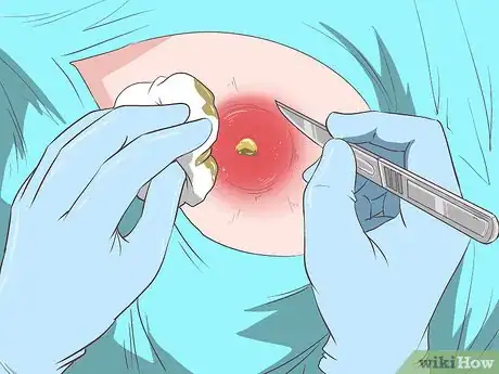 Image titled Recognize Staph Infection Symptoms Step 13