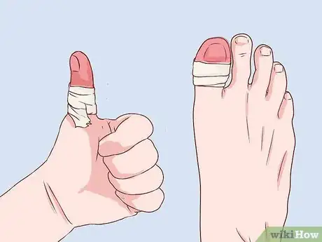 Image titled Bandage Fingers or Toes Step 16