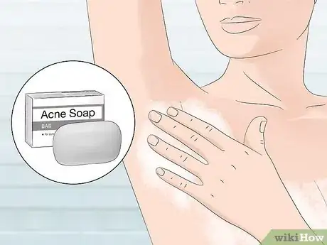 Image titled Stop Armpit Pimples Step 11