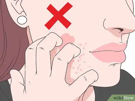 Image titled Get Rid of a Rash on Your Face Step 4