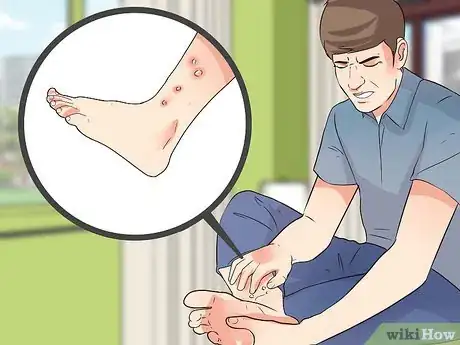 Image titled Cure Impetigo Step 3