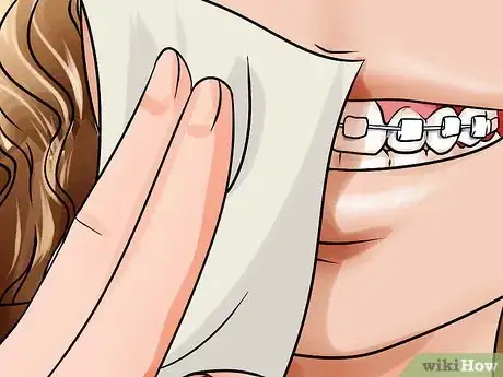 Image titled Apply Dental Wax on Braces Step 5