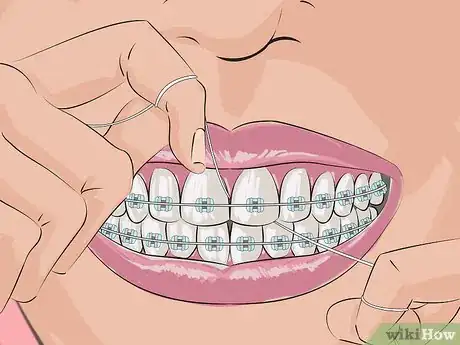 Image titled Deal with Braces Step 2