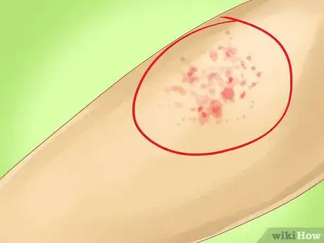 Image titled Identify Measles Step 3