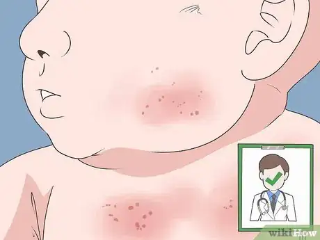 Image titled Get Rid of Baby Acne Step 9