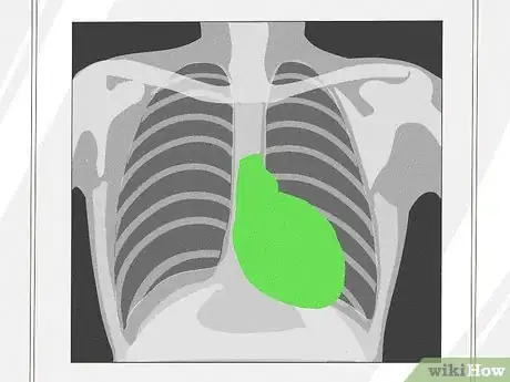 Image titled Know if a Chest X Ray Film Is Rotated Step 5