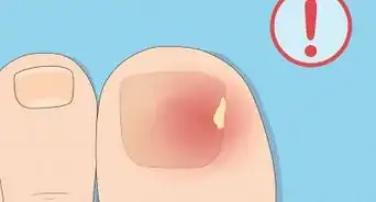 Remove a Dead Toenail