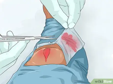 Image titled Apply a Pressure Bandage Step 2