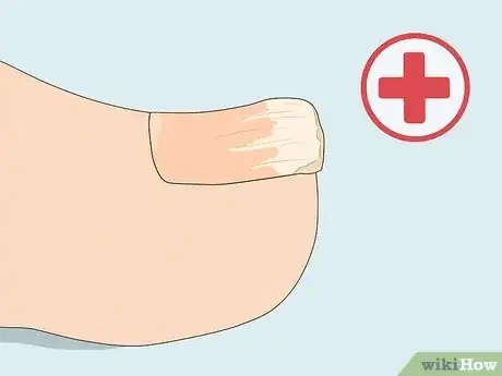 Image titled Cure Nail Fungus Step 20