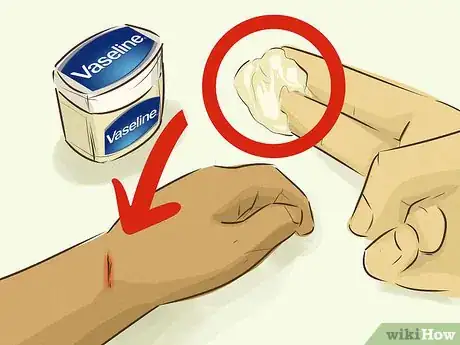 Image titled Stop Bleeding Step 2