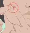 Get Rid of a Zit Overnight