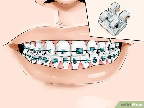 Image titled Connect a Rubber Band to Your Braces Step 2