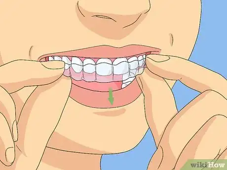 Image titled Clean Invisalign Step 1