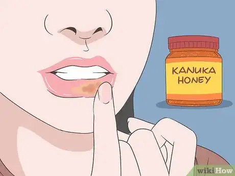 Image titled Get Rid of a Cold Sore with Home Remedies Step 1