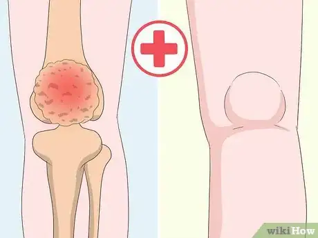 Image titled Get Rid of Leg Pain Step 15