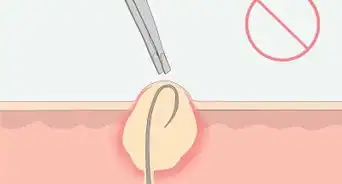 Get Rid of Ingrown Pubic Hair