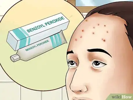 Image titled Get Rid of Forehead Acne Step 1