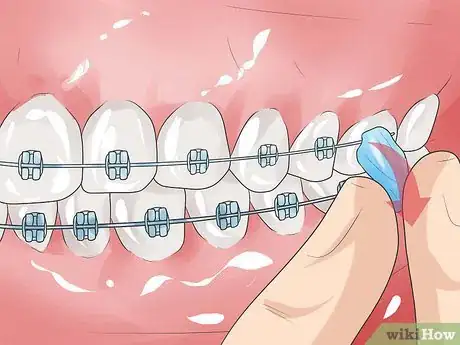 Image titled Handle Poking Wires on Braces Step 5