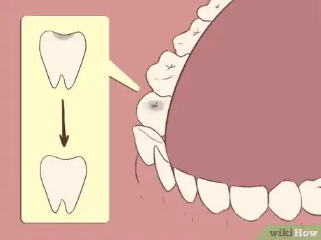 Image titled Alleviate Toothache Pain Step 9