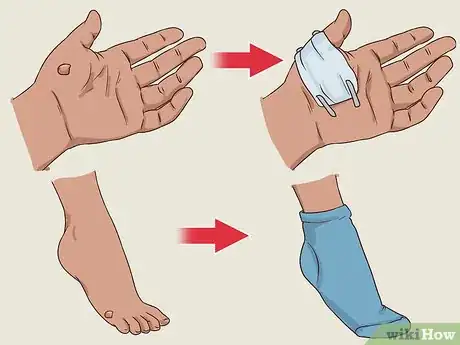 Image titled Get a Wart Surgically Removed Step 4