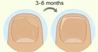 Heal Damaged Nails