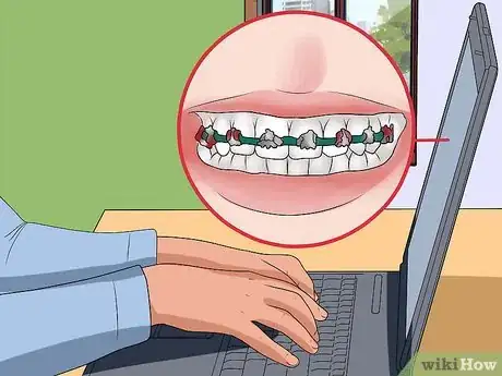 Image titled Make Braces Look Less Noticeable Step 6