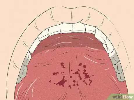 Image titled Differentiate Bacterial Tonsillitis and Viral Tonsillitis Step 5