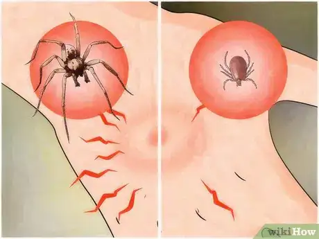 Image titled Identify a Spider Bite Step 7