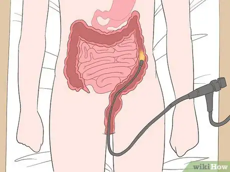 Image titled Recognize Colon Cancer Symptoms Step 8