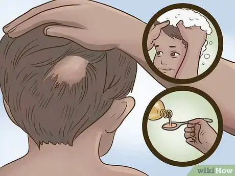 Image titled Stop Hair Loss in Children Step 8