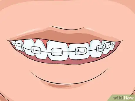 Image titled Choose the Color of Your Braces Step 11