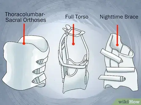 Image titled Reduce Scoliosis Curvature Step 2